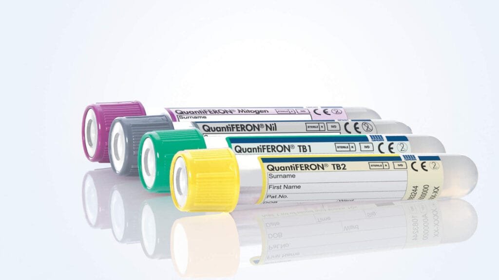 QuantiFERON-TB Gold Plus diagnóstico de coinfección VIH-TB